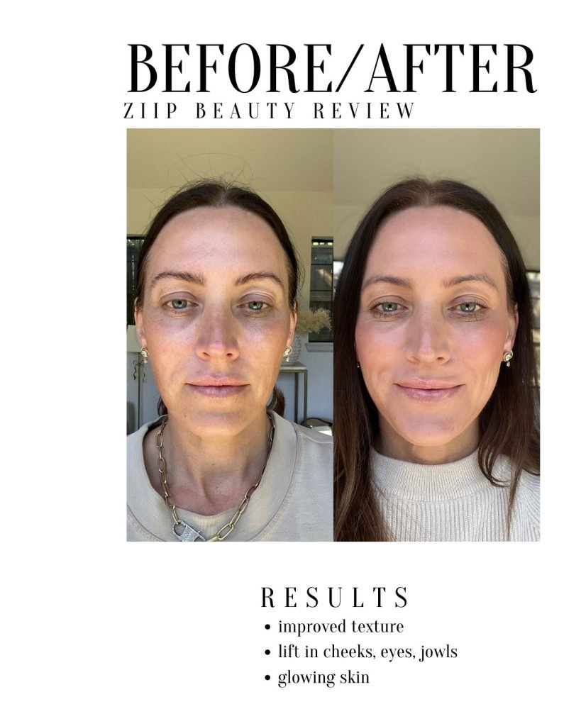 Before and AFter Ziip results | My honest Ziip review