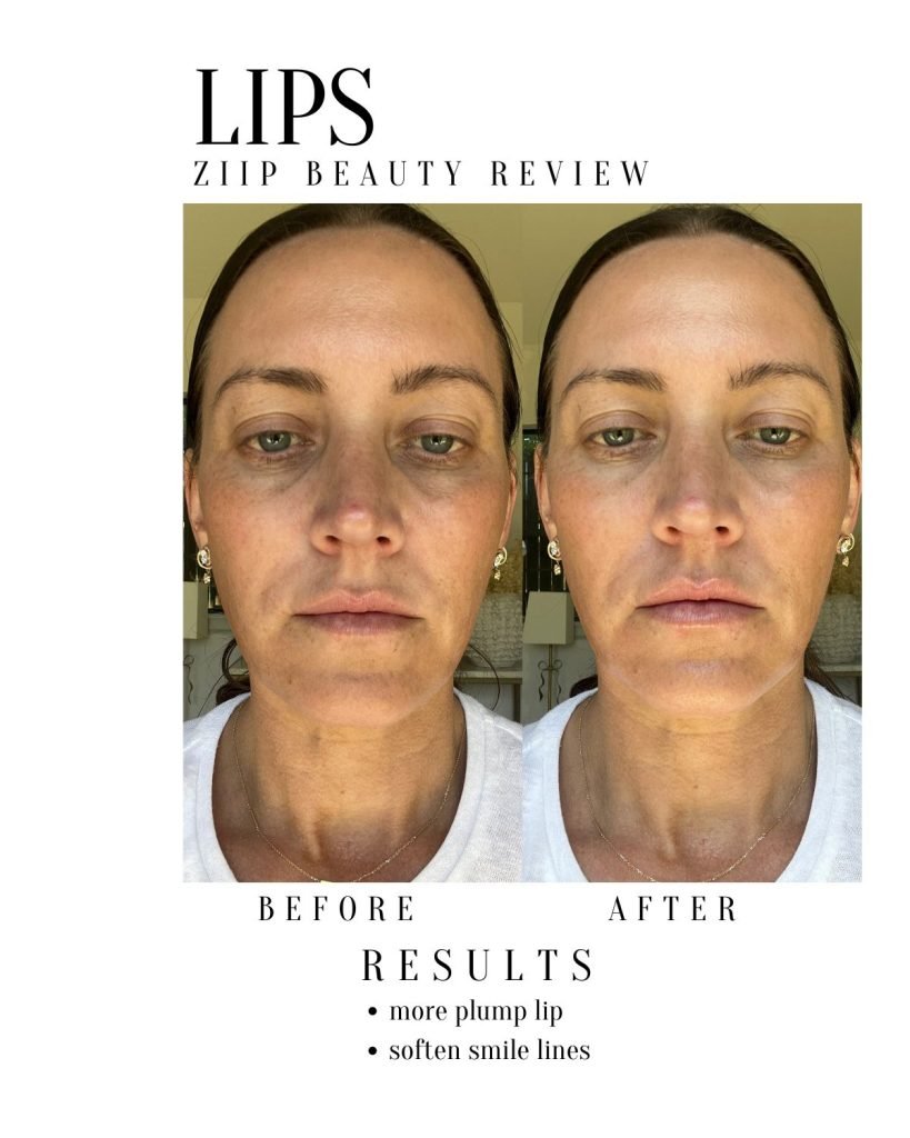 Before and AFter Ziip results lips | My honest Ziip review
