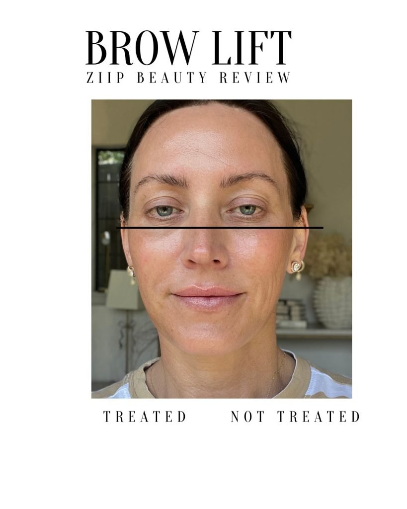 Before and AFter Ziip results brow lift