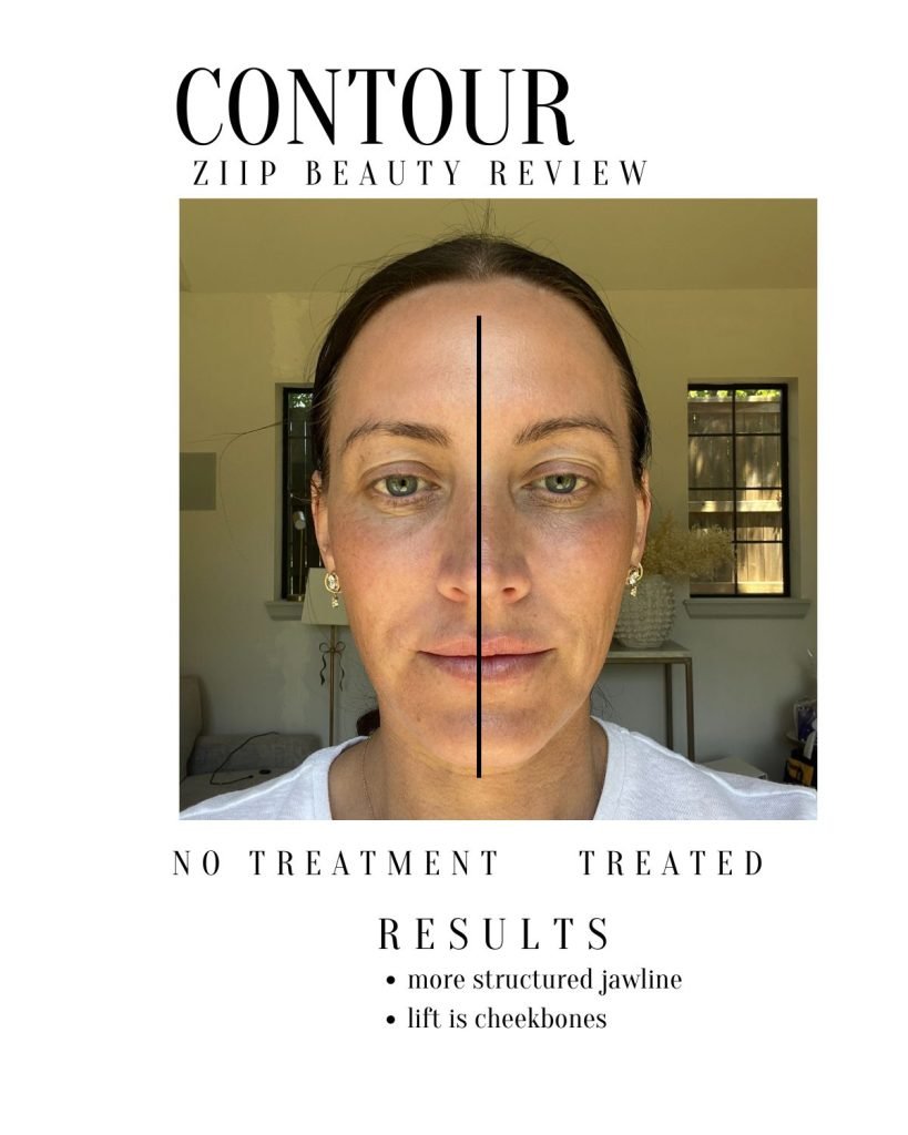 Before and AFter Ziip results contour