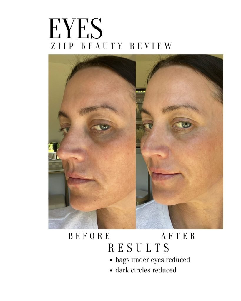 Before and AFter Ziip results eyes